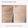 RF Body Device - Masderm Cosmética