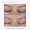 RF Tratamiento Antiarrugas - Masderm Cosmética