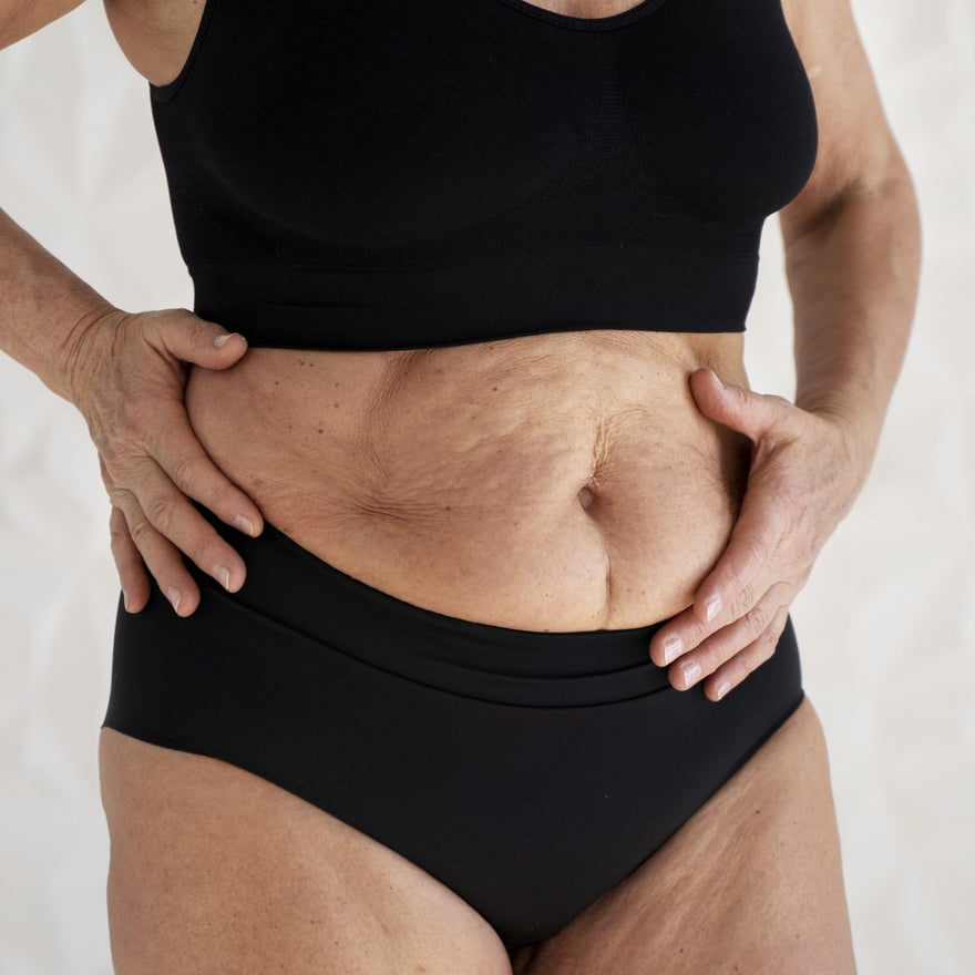 Celulitis en la barriga: causas y cómo eliminarla con radiofrecuencia corporal - Masderm Cosmética