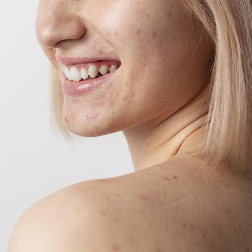 El mejor tratamiento para quitar las marcas de acné - Masderm Cosmética