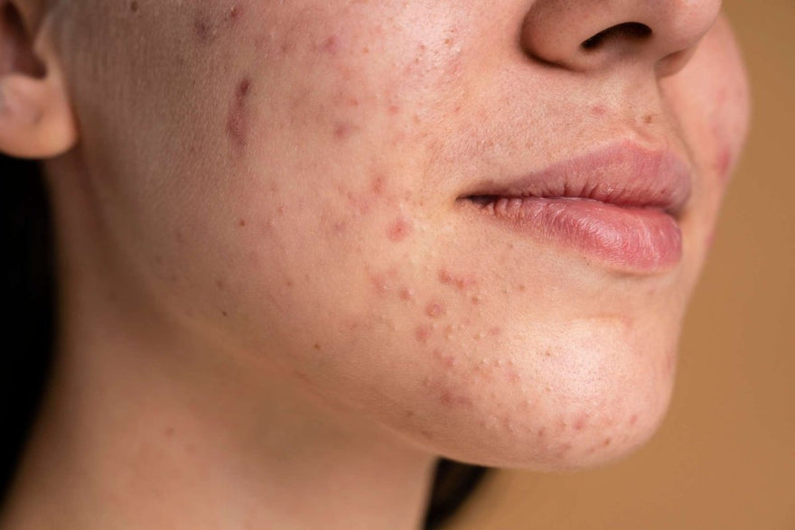 El mejor tratamiento para quitar las marcas de acné - Masderm Cosmética