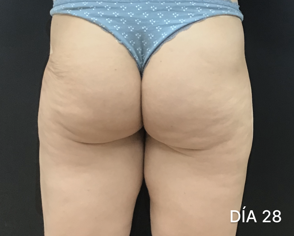 Dispositivo para lipomas