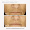 RF Tratamiento Despigmentante - Masderm Cosmética
