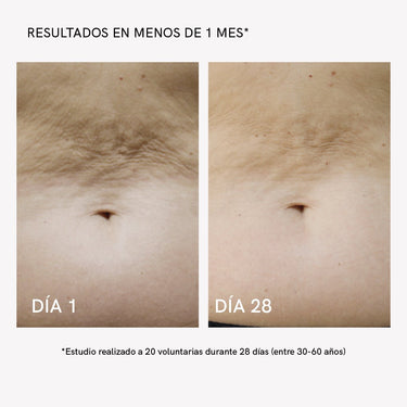 RF Tratamiento Flacidez Corporal - Masderm Cosmética