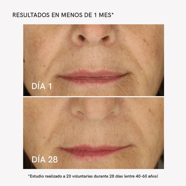 RF Tratamiento Flacidez Facial - Masderm Cosmética