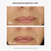 RF Tratamiento Flacidez y Arrugas - Masderm Cosmética