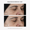RF Tratamiento Flacidez y Arrugas Plus - Masderm Cosmética
