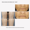 RF Tratamiento Radiofrecuencia Completo - Masderm Cosmética